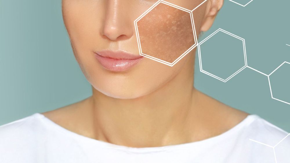HYPERPIGMENTATION ~ DARK SPOTS ~ AGE SPOTS ~ SUN DAMAGE