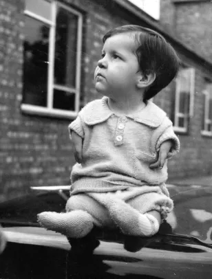 Example of Thalidomide child missing body parts