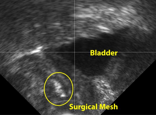 Surgical mesh implant, dysfunctional