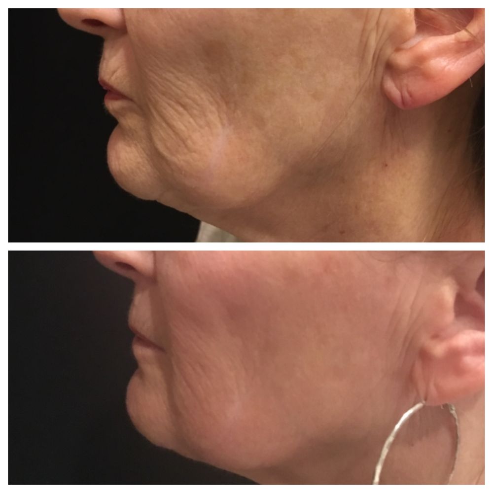 Dr Bellaire client after 2 RF Pixel treatments