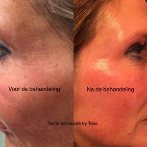 Na 1 behandeling Chemical Peel
