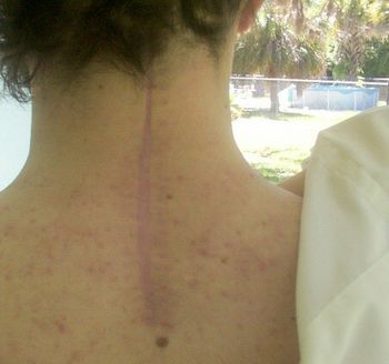 "Broken Neck Stops Florida Artist' Mazz's 2nd Spinal Surgery, March 2001. (After 3 months the Cast/Hard Collar is temporarily removed). After months/year of recuperation, Mazz has regained most of the feeling back in his painting hand and now paints on a limited basis.