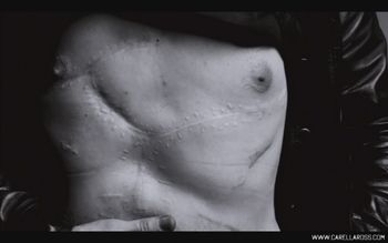 Andy_Warhol_Chest_Scars1
