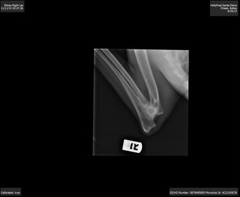 OFA Right Elbow
