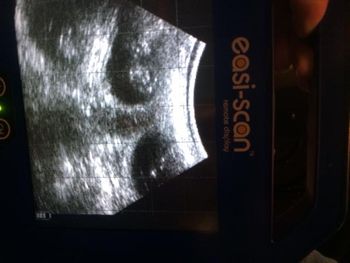 Ultrasound  5/2/17
