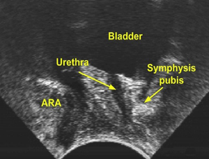 Transperineal ultrasound, normal female, ARA = ano-rectal angle