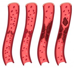 Diagram: progression of blood clots in  blood vessels