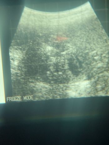 4/18/22 ultrasound
